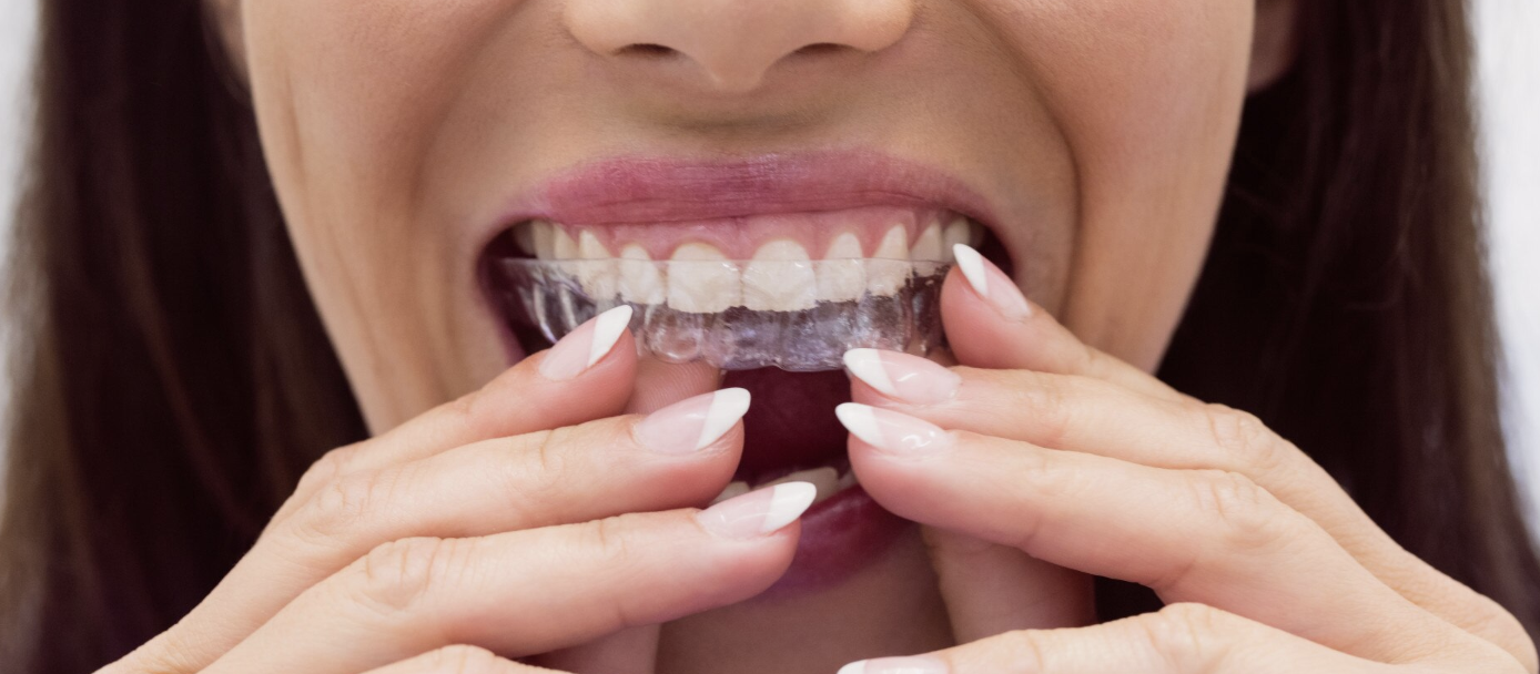 Invisalign vs Braces : A Complete Guide